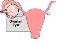 kanker-ovarium-1